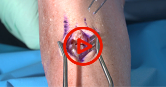 Achilles Mid-Substance Repair