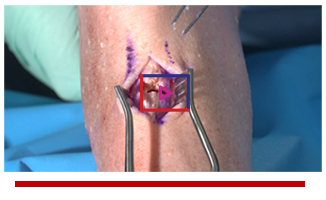 Achilles Mid-Substance Repair - Graham Hamilton, DPM Image