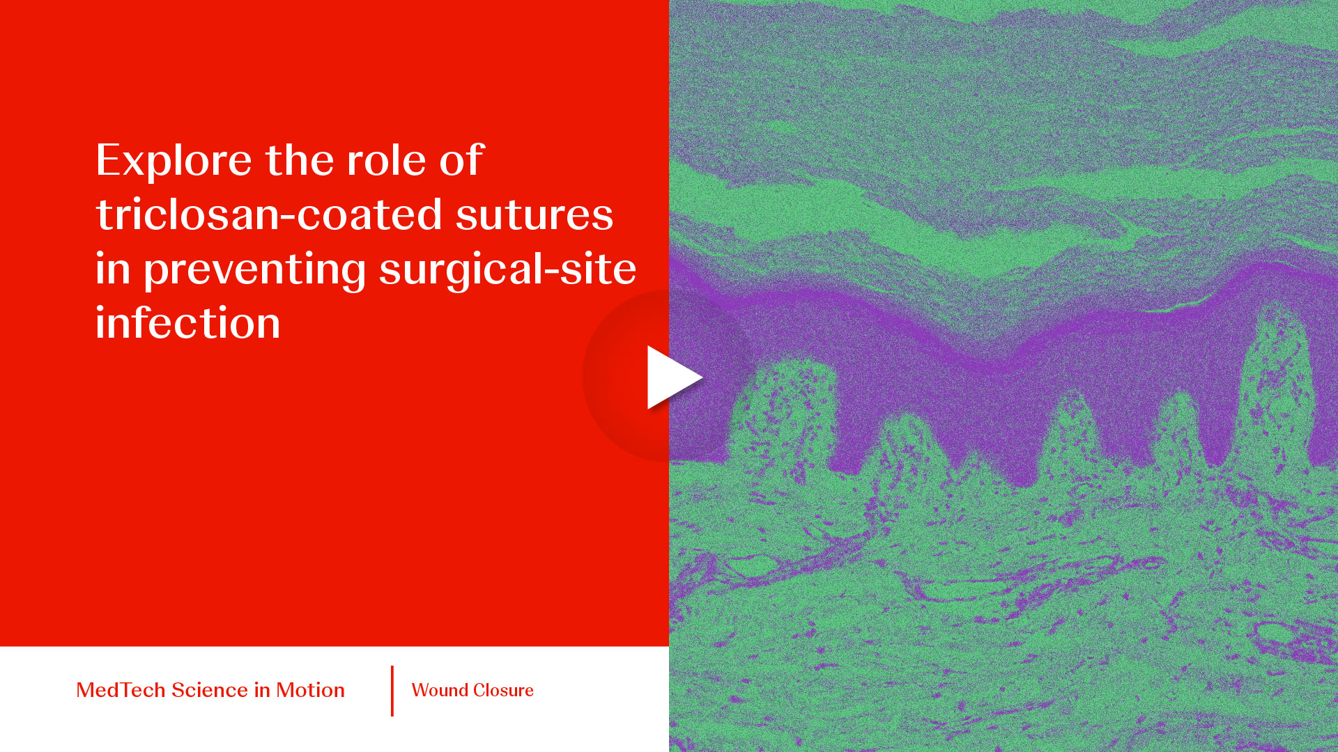 thumb Explore the role of triclosan-coated suture