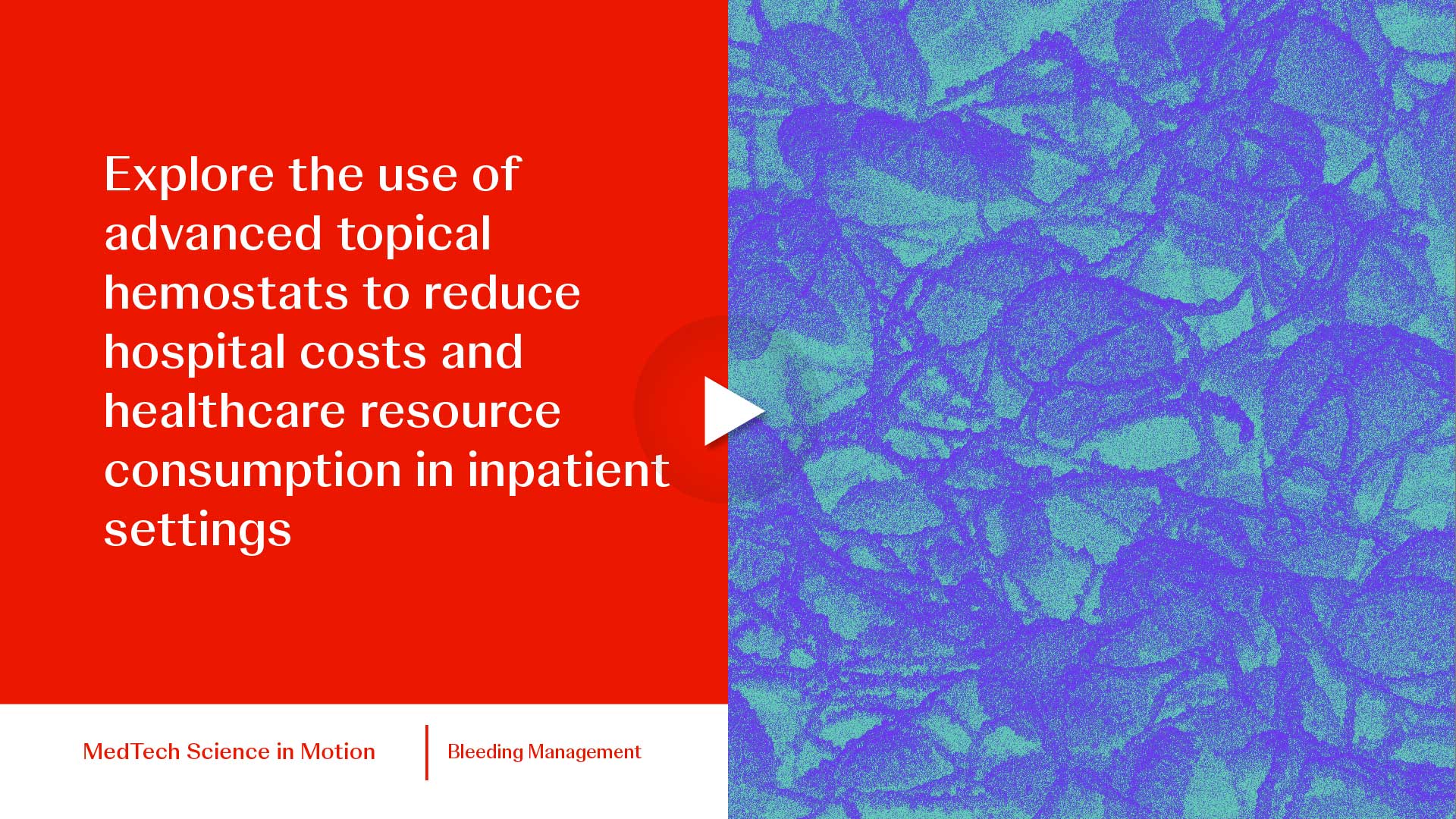 thumb Explore the use of advanced topical hemostats to reduce hospital costs and healthcare resource consumption in inpatient settings