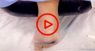 Flexor Digitorum Longus Tendon Transfer