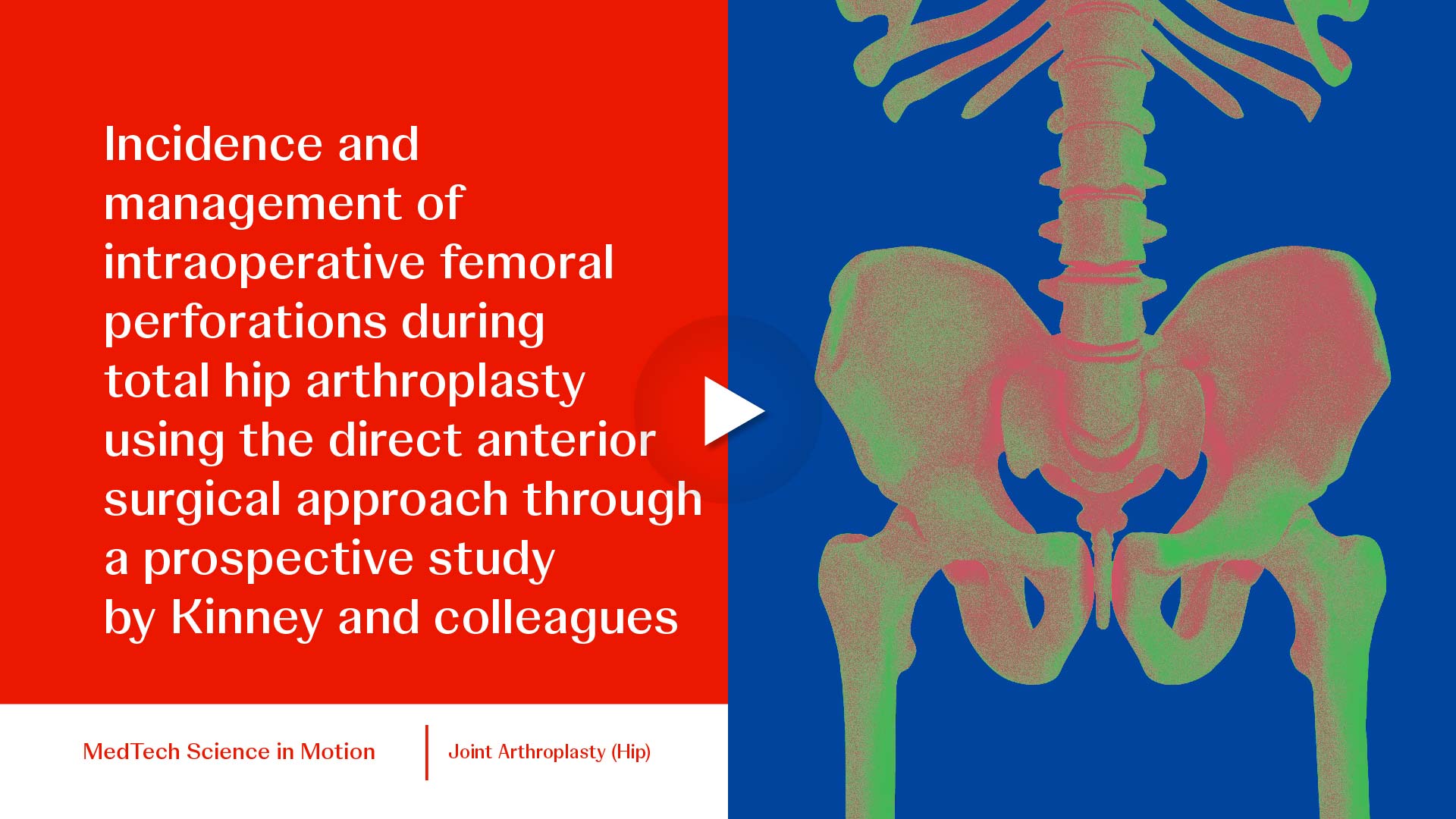 thumb Managing Complexities: DAA Hip Arthroplasty