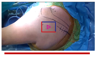 Arthroscopic Assisted Lower Trapezius Transfer and Rotator Cuff Repair - Paul Favorito, MD Image