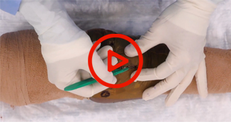 Medial Patellofemoral Ligament Recon