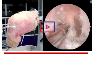 Posterior Cruciate Ligament Reconstruction - Michael Alaia, MD Image