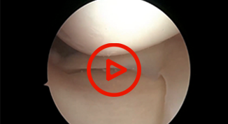 Posterolateral Corner Recon