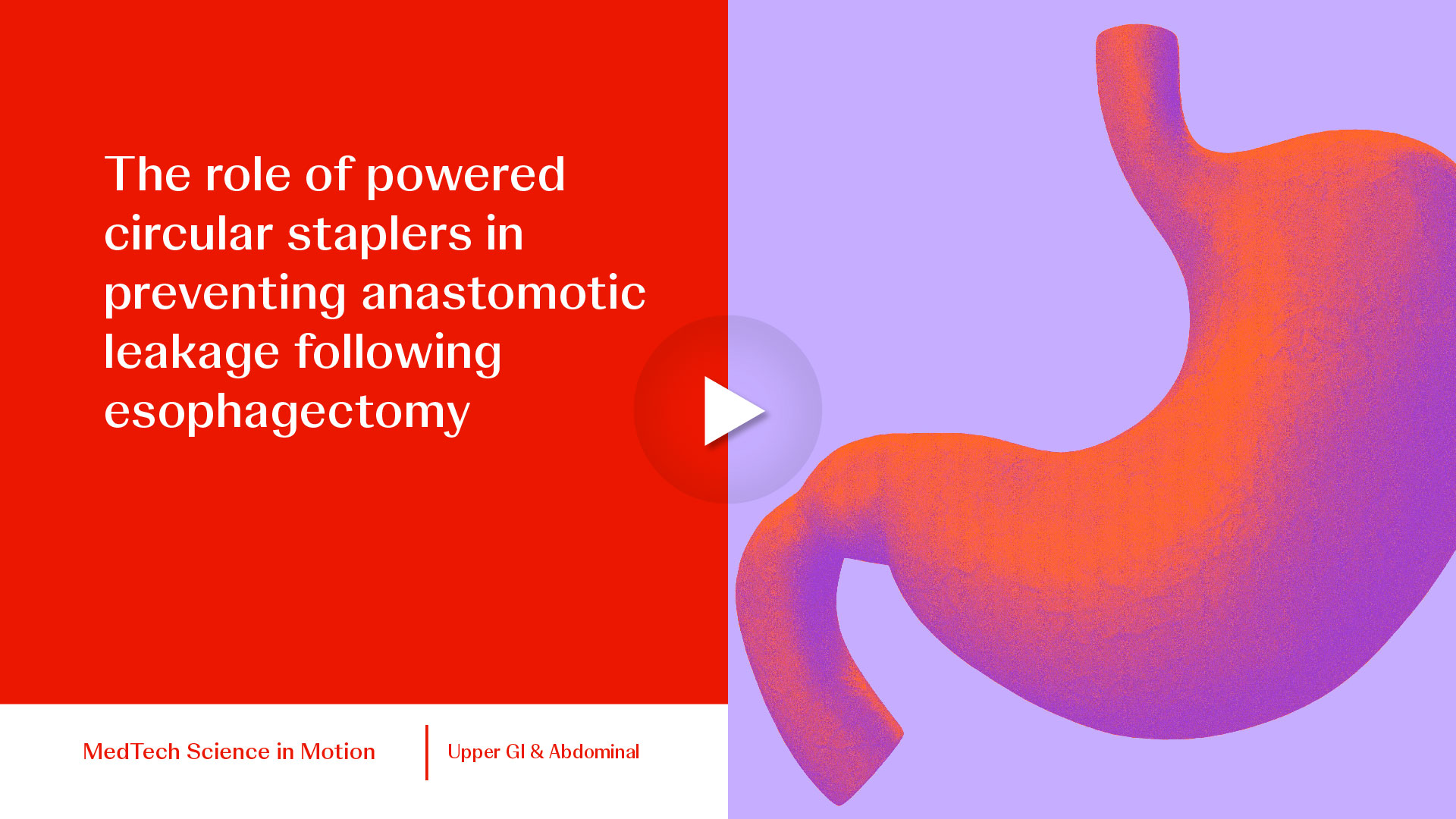 thumbThe role of powered circular staplers in preventing anastomotic leakage following esophagectomy