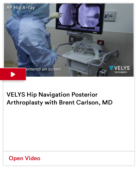 VELYS Hip Navigation Posterior Arthroplasty - Brent Carlson, MD