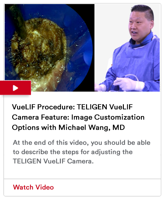 VueLIF Procedure Image