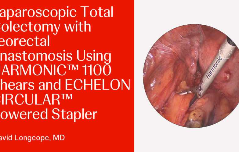Laparoscopic Total Colectomy with Ileorectal Anastomosis Using HARMONIC™ 1100 Shears and ECHELON CIRCULAR™ Powered Stapler