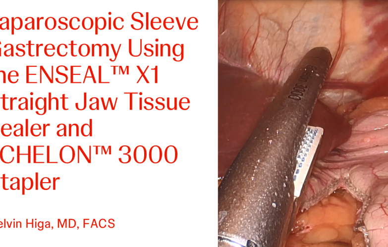 An Image From "Laparoscopic Sleeve Gastrectomy Using the ENSEAL™ X1 Straight Jaw Tissue Sealer and ECHELON™ 3000 Stapler with Kelvin Higa, MD"