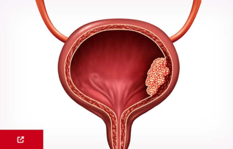 An Image From "Non–Muscle-Invasive Bladder Cancer (NMIBC)"