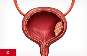 An Image From "Non–Muscle-Invasive Bladder Cancer (NMIBC)"