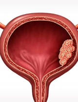 An Image From "Non–Muscle-Invasive Bladder Cancer (NMIBC)"