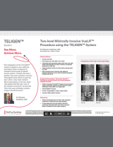 An Image From "Two-level Minimally Invasive VueLIF™ Procedure using the TELIGEN™ System - Wissam Asfahani, MD"