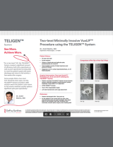 An Image From "Two-level Minimally Invasive VueLIF™ Procedure using the TELIGEN™ System - Ankit Mehta, MD"