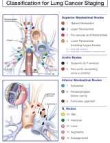 An Image From "Regional Lymph Node Classification for Lung Cancer Staging"