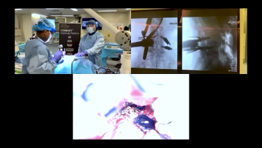 Minimally Invasive TLIF Procedure Workflow with Shirvinder Wijesekera, MD