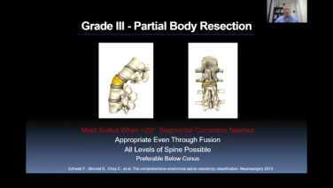 Osteotomies: Pedicle Subtraction with Stuart Hershman, MD