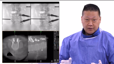 MIS TLIF Procedural Workflow enabled by TELIGEN System with Michael Wang, MD