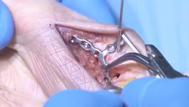 VA Locking Hand System with Thomas Fischer, MD
