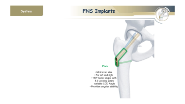 Femoral Neck System: An Innovative Solution for Femoral Neck Fractures with Christopher Finkemeier, MD & Karl Stoffel, MD