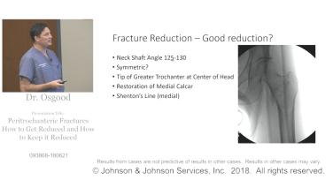 An image of the "Peritrochanteric Hip Fractures: How to Get Reduced & Keep Reduced with Greg Osgood, MD" video.