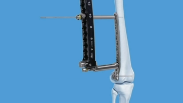 4.5 MM VA LCP™ Curved Condylar Plate Distal Femur Fracture Plating Guide