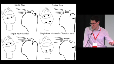 An image from the "Massive Cuff Tear: Strategies & Techniques with Peter Chalmers, MD" video on the JnJInstitute.com website.