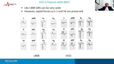 An Image From "Clinical Cardiac Electrophysiology Evolution & Clinical Cases with Jasbir Sra, MD"