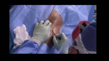 ANTERIOR ADVANTAGE™ Standard Table THA Surgical Technique with Lee Rubin, MD