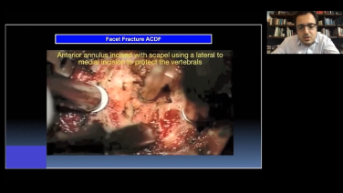 Anterior Cervical Approach Case Presentation with Eiman Shafa, MD