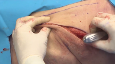 Posterior Approach to Rib Fixation with Tim Pohlman, MD