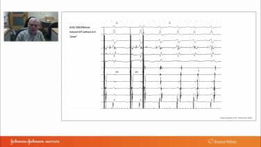 An Image From "AVNRT LLAP Case Presentation with Melvin Scheinman, MD"