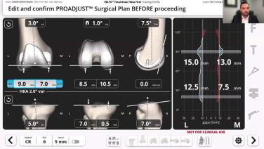 VELYS Robotic-Assisted Solution Case Walkthrough with Dr. John Redmond thumbnail