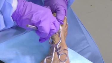 The start of Hallux Valgus Deformity Surgical Technique - Brian Loder, DPM