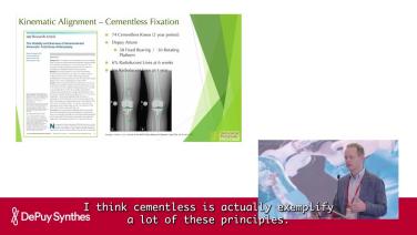 Slide from Fundamental of Kinematic Alignment and Clinical Outcomes with Bryan Haughom, MD
