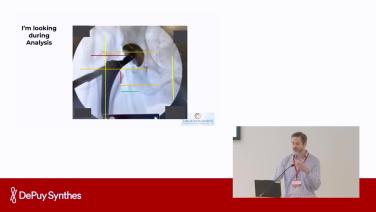 Slide from Technology in the OR; VELYS Hip Navigation™, CUPTIMIZE Advanced™ and KINCISE 2 Surgical Automated System™ with Joe Gondusky, MD