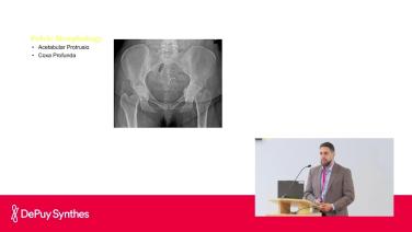 Slide image from Anterior Advantage™ Direct Anterior Total Hip Arthroplasty; Preoperative Preparation with Khalid Yousef, MD
