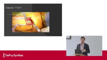 Slide image of a open wound from ANTERIOR ADVANTAGE™ Primary Hip Course; Femoral Neck Cut and Exposure with Joshua Lindsey, MD