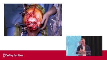 Slide from the presentation in VELYS™ Robotic-Assisted Solution: Kinematic Alignment with Kevin Perry, MD