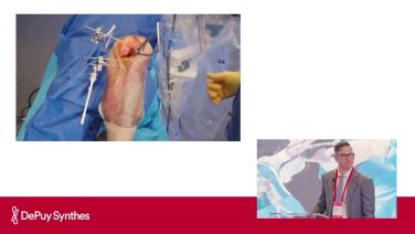 Slide from VELYS™ Surgery Demo: Inverse Kinematic Alignment with Timothy Alton, MD