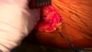 a step during the procedure of ANTERIOR ADVANTAGE™ Total Hip Arthroplasty with Hana® Table Live Procedural Workflow with Joel Matta, MD