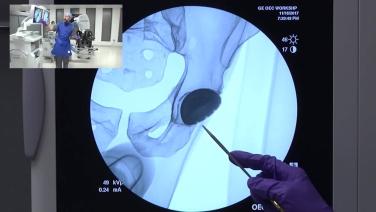a step during the procedure in ANTERIOR ADVANTAGE™ Total Hip Arthroplasty with Hana® Table Tips & Pearls with Joseph Schwab, MD