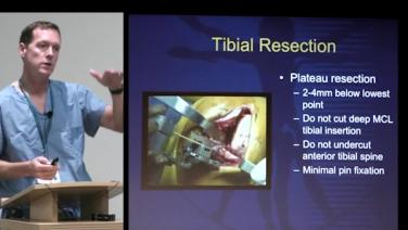 Slide from Unicompartmental Knee Arthroplasty; Surgical Technique Webinar with Craig Morrison, MD