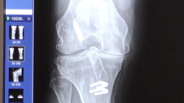 X-ray from Total Knee Arthroplasty; Pre-Operative Patient Review & Anesthetic Blocks with William Barrett, MD & Jana Flener, PA-C
