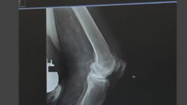 X-ray of a elbow from ATTUNE KNEE System and INTUITION Instruments Procedure Workflow and Review with David Dalury, MD & David Fisher, MD