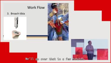 Addressing Fixation in Revision Knees with Sleeves and Rotating Platform with Zachary Post, MD thumbnail