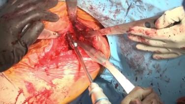 open knee during Understanding Your Poly Options: Medial Stabilized with Wayne Moschetti, MD
