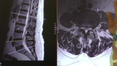 x-ray from a spine from Single Position ATP Surgical Technique with Chi Lim, MD
